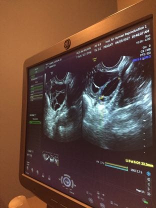 Hospital monitor for the ultrasound during the IVF procedure